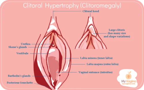 chandresh pandey recommends pictures of women with large clitoris pic