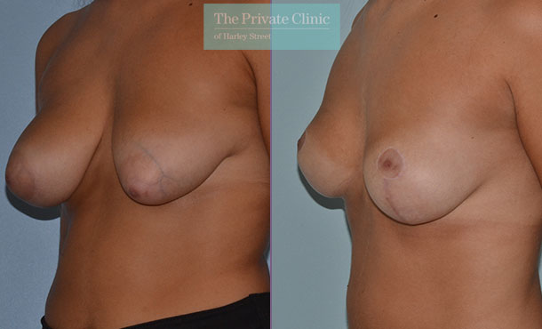 bharti dhyani recommends long nipplles pic