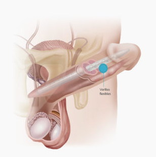 anwarkhan khan recommends old man penile implant videos porn pic