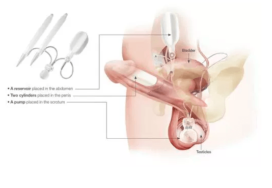 Penile Implant Porn a trapani