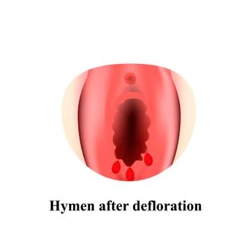 chris lawther recommends defloration of the hymen pic