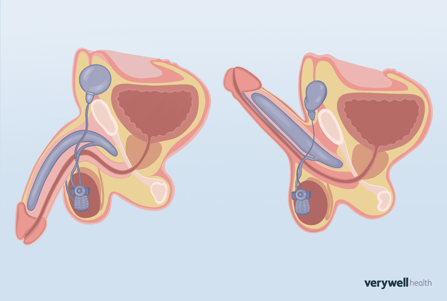 Best of Penile implant porn