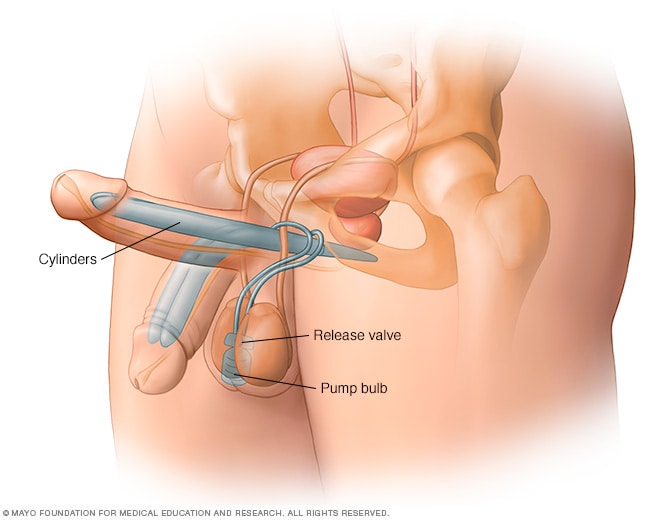 penile implant porn