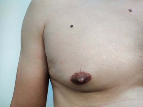 puffy women nipple